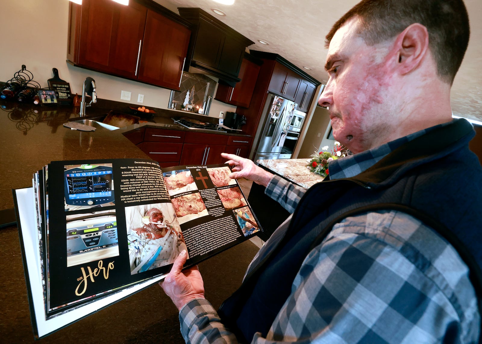 Kevin Pleiman looks over photos of himself in a book his wife, Shelly, made for him documenting his recovery from an accident last December that left him with severe burns  over 70% of his body. BILL LACKEY/STAFF