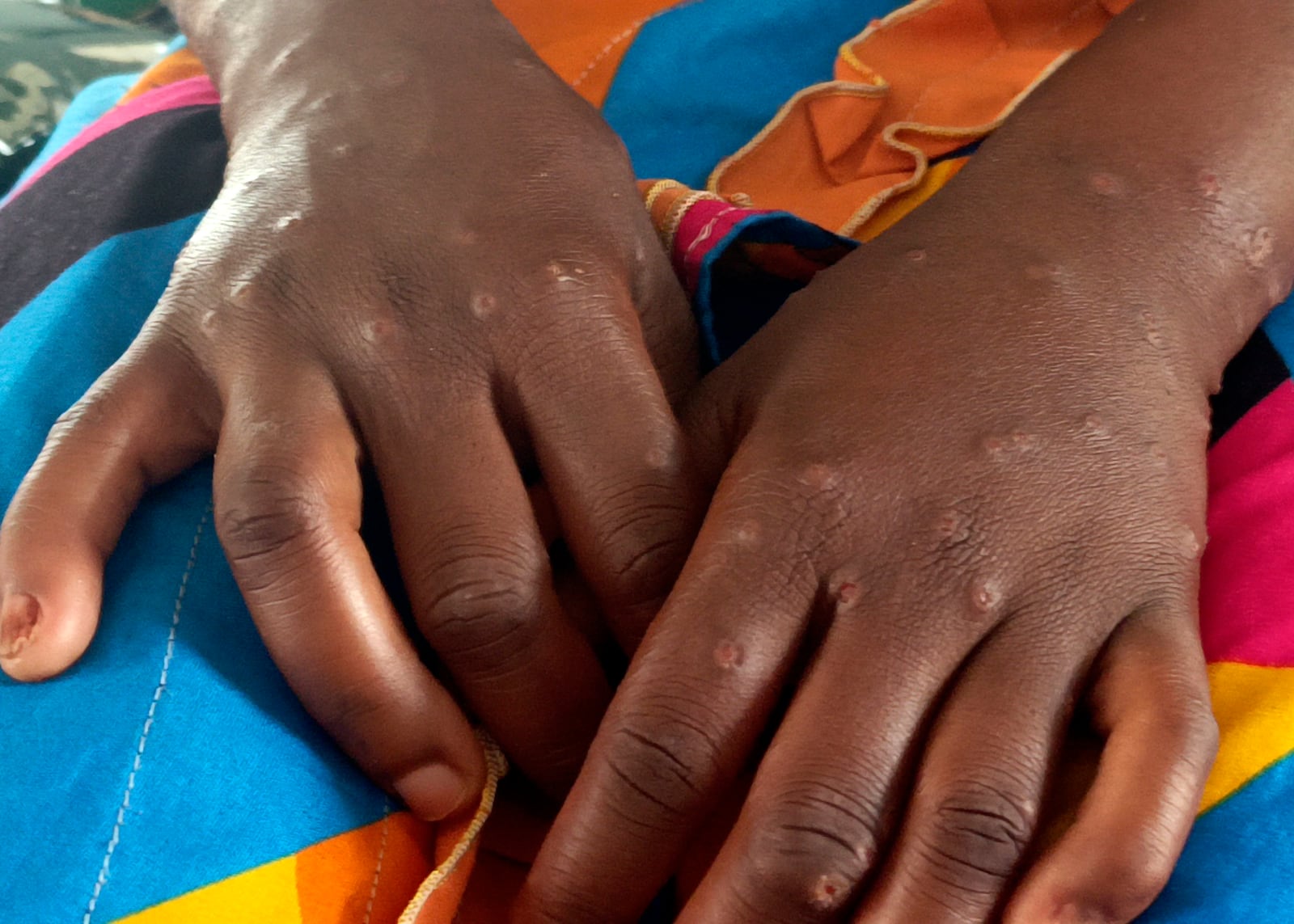 Mpox scars are seen on the hands of Bintu Biringingwa, at the Miti Murhesa hospital, some 25kms from Bukavu, Democratic Republic of the Congo, Thursday, March 6, 2025. (AP Photo/Janvier Barhahiga)