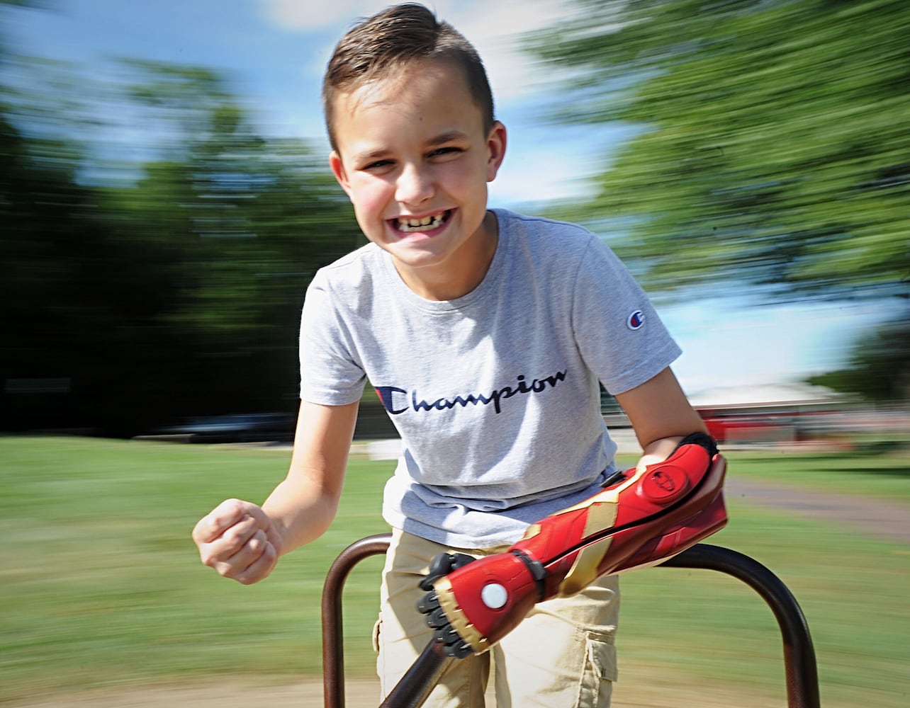 Boy has 'Iron Man' arm