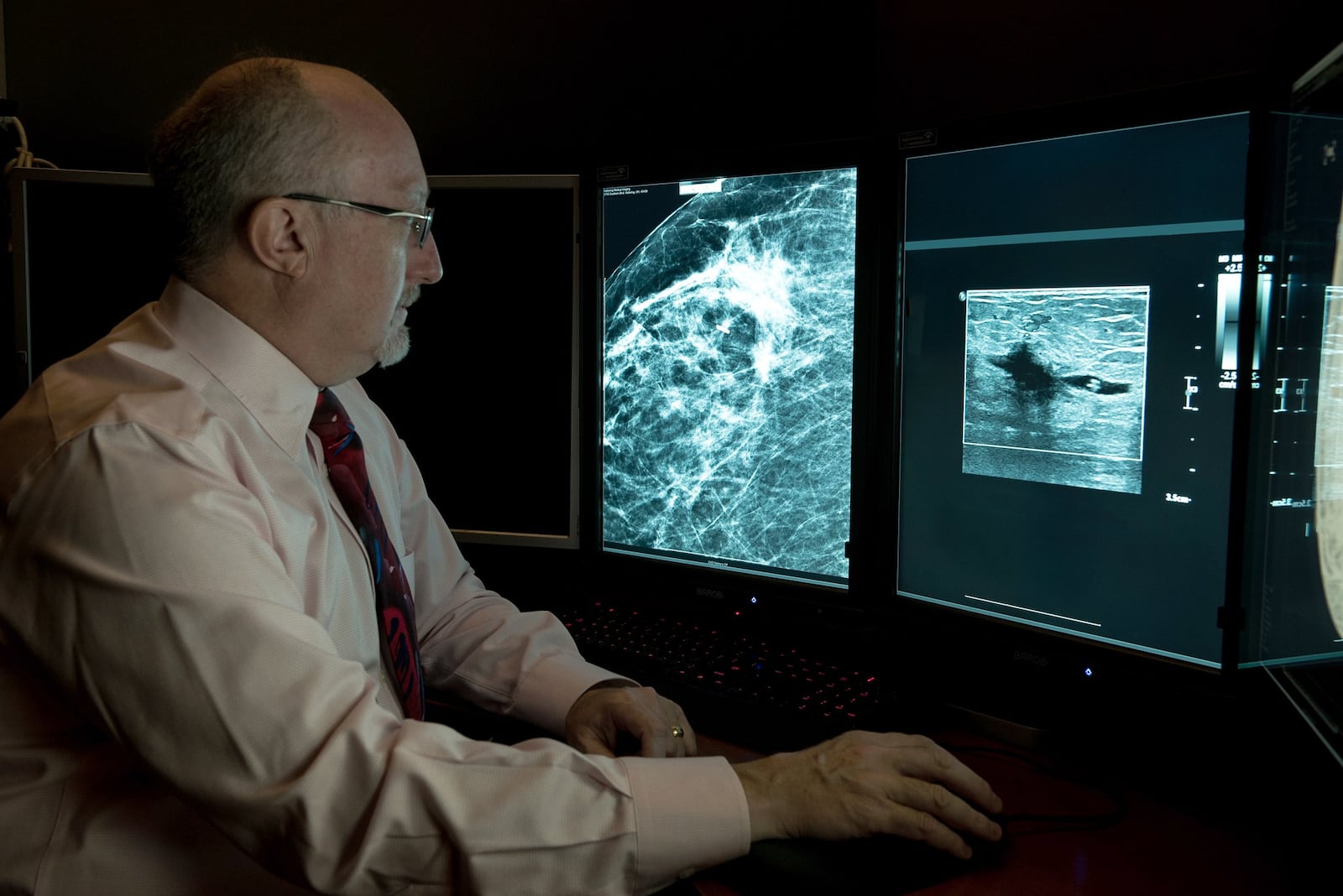 FILE - Diagnostic radiologist Dr. William Meyers with Kettering Health reads an ultrasound to determine the seed location and identify the area of affected breast tissue to be removed. CONTRIBUTED