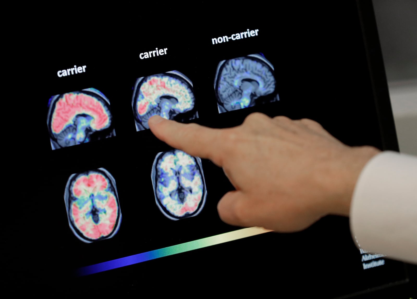 FILE - A doctor looks at PET brain scans at Banner Alzheimers Institute in Phoenix on Aug. 14, 2018. (AP Photo/Matt York, File)