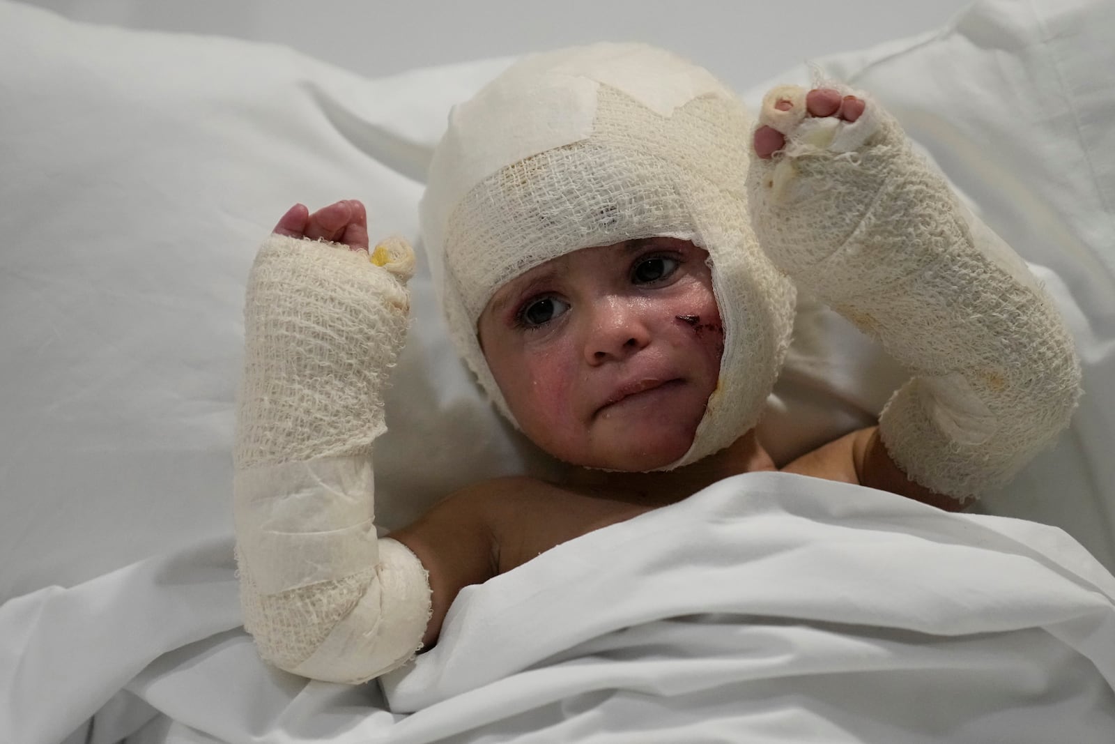 FILE - A Lebanese child with burns over 40 percent of her body following an Israeli airstrike in September near their home in Deir Qanoun al Nahr, lies on a hospital bed in Beirut, Lebanon, on Oct. 29, 2024. (AP Photo/Hussein Malla, File)