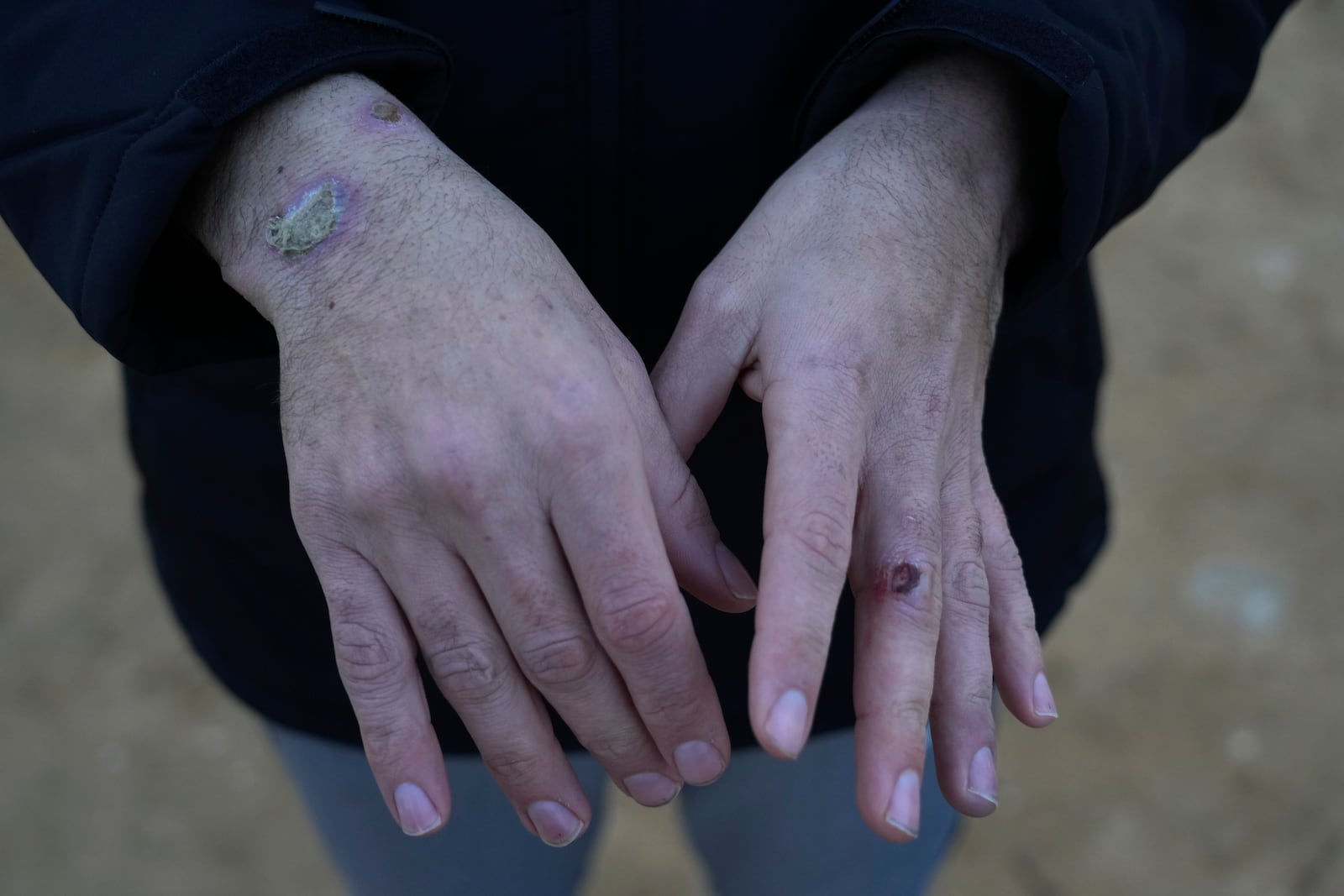 A freed Palestinian prisoner shows wounds on his hands on arrival to the Gaza Strip after being released from an Israeli prison following a ceasefire agreement between Hamas and Israel in Khan Younis, Gaza Strip, Thursday, Feb. 27, 2025. (AP Photo/Abdel Kareem Hana)