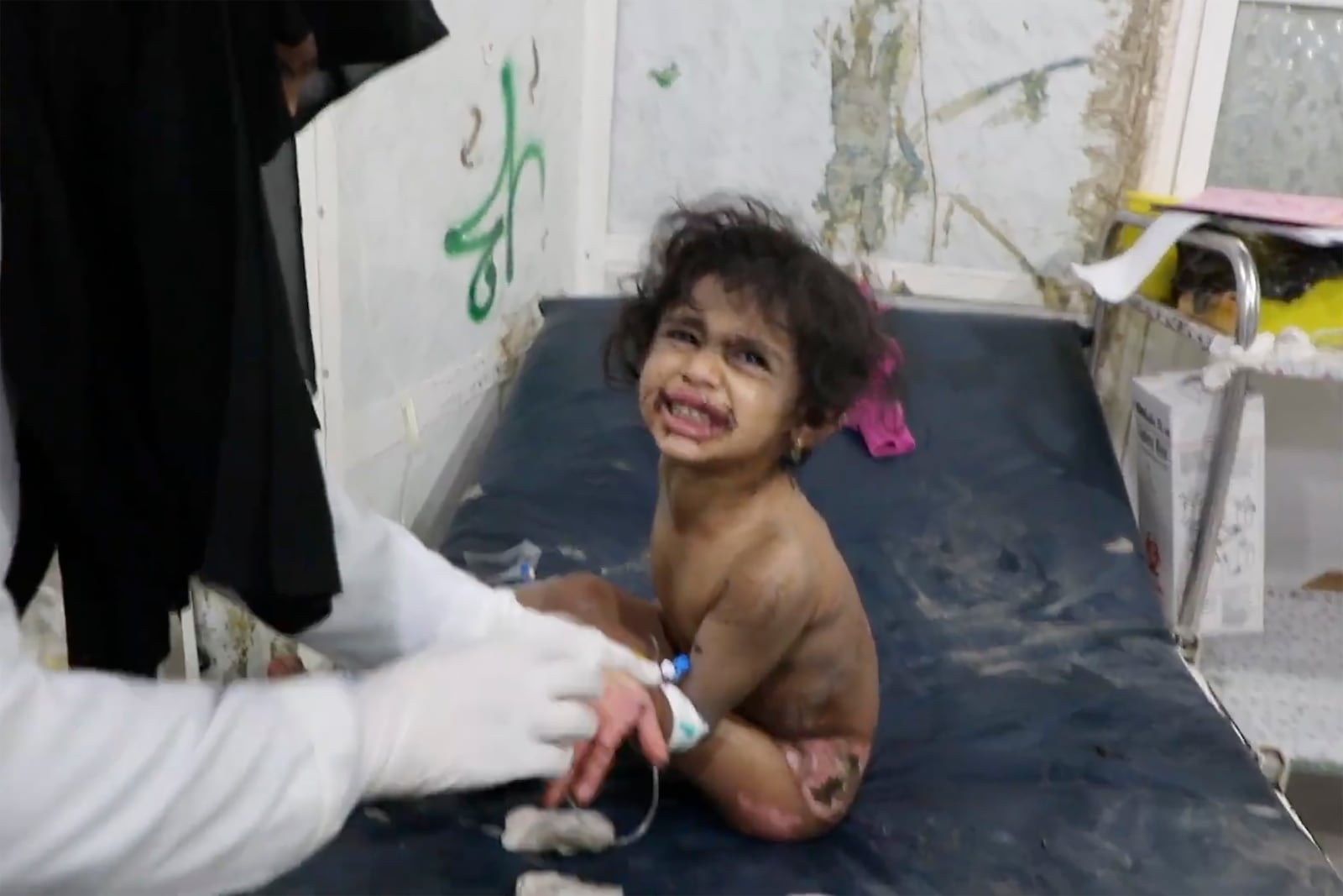 In this photo taken from video released by Ansar Allah Media Office via Al Masirah TV channel shows a girl being treated at a hospital in Saada, Yemen, Saturday, March 15, 2025 following airstrikes over multiple targets in the country. The Houthi-run Health Ministry said the overnight strikes killed at least 31 people, including women and children, and wounded over 100 in the capital of Sanaa and the northern province of Saada, the rebels' stronghold on the border with Saudi Arabia.( Al Masirah TV via AP)