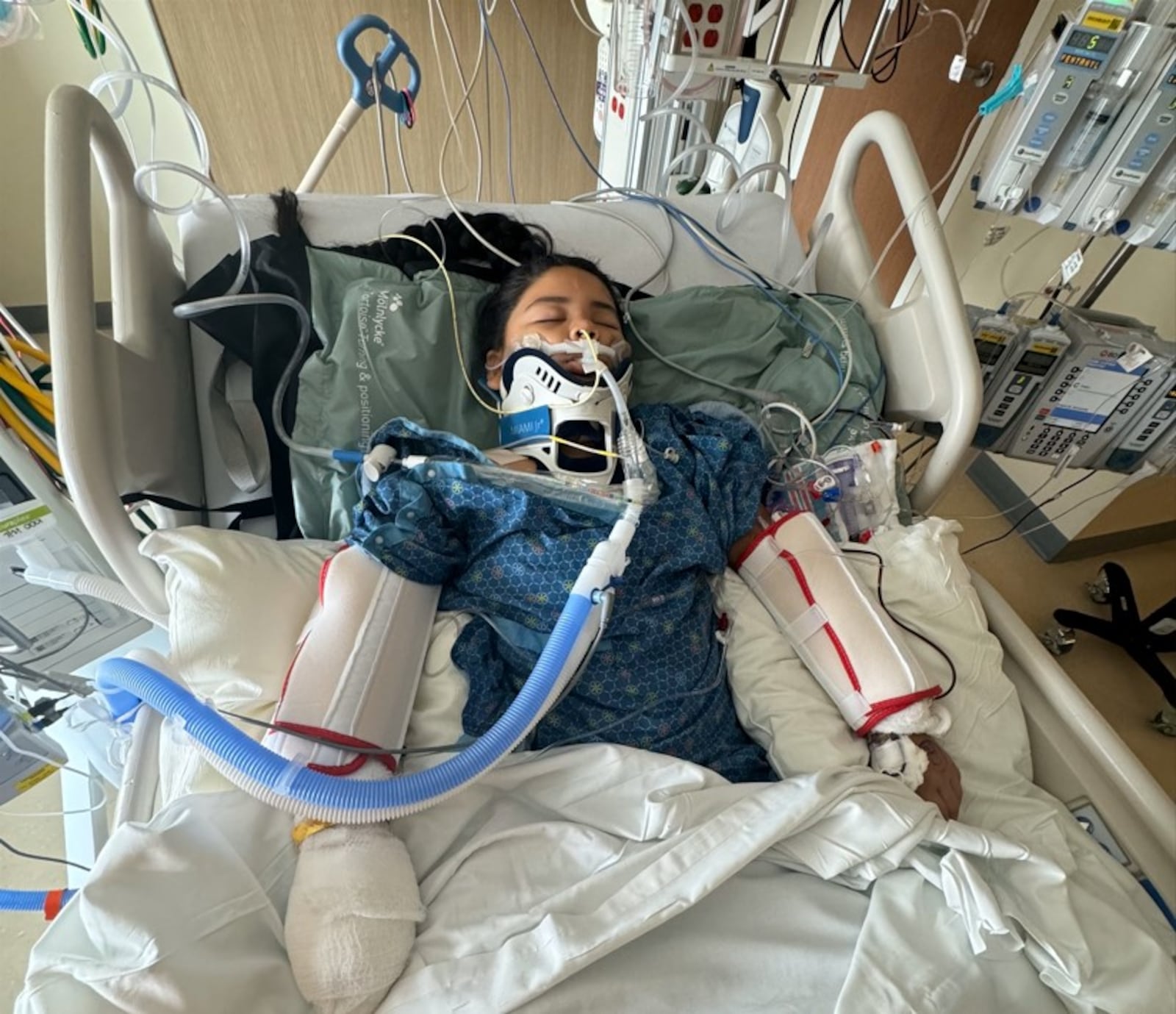 Ashley Escalante, 9, of Dayton, was in a coma for 10 weeks after she was struck by a hit-and-run driver on July 22, 2024. Her left foot was amputated and she nearly lost her right foot. CONTRIBUTED 